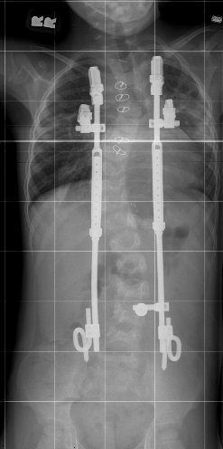 VEPTR Rods - scoliosis